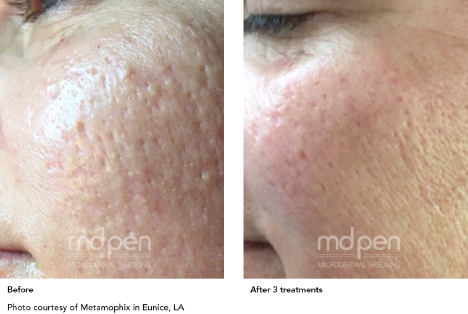 Microneedling collagen induction therapy at Desert Sands Aesthetics, St. George Utah