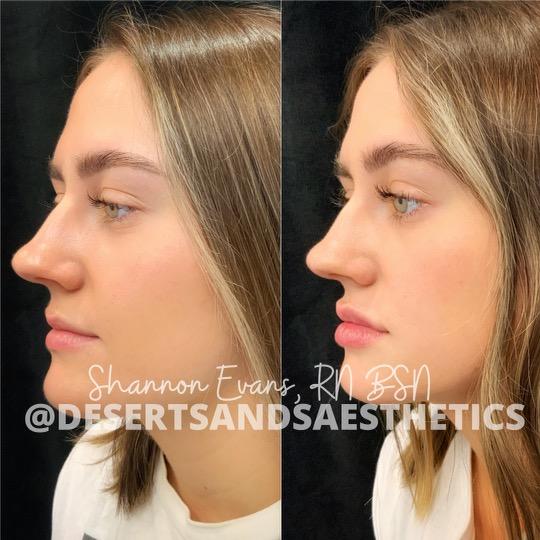 Juvéderm filler before and after result — Desert Sands Aesthetics & Laser, St. George Utah