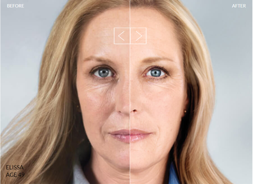 Sculptra and Radiesse collagen biostimulator injectable treatments at Desert Sands Aesthetics & Laser, St. George Utah