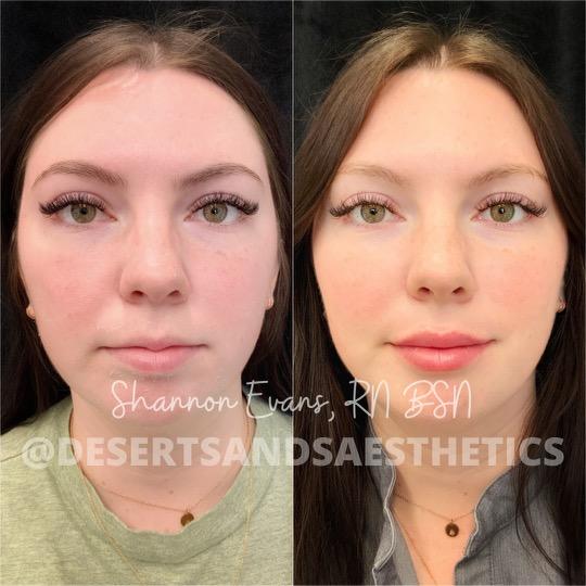 Juvéderm filler before and after result — Desert Sands Aesthetics & Laser, St. George Utah