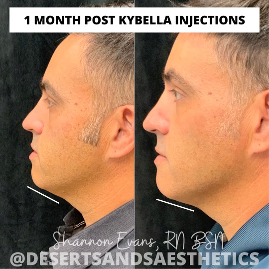 KYBELLA double chin treatment at Desert Sands Aesthetics & Laser, St. George Utah