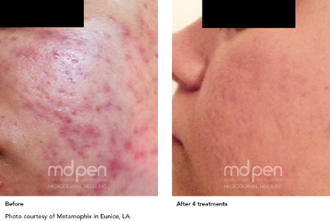 Microneedling before and after skin texture results — Desert Sands Aesthetics, St. George Utah