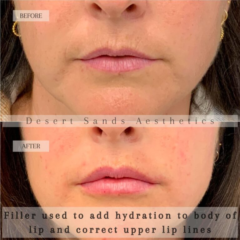 Restylane dermal filler treatment at Desert Sands Aesthetics & Laser, St. George Utah