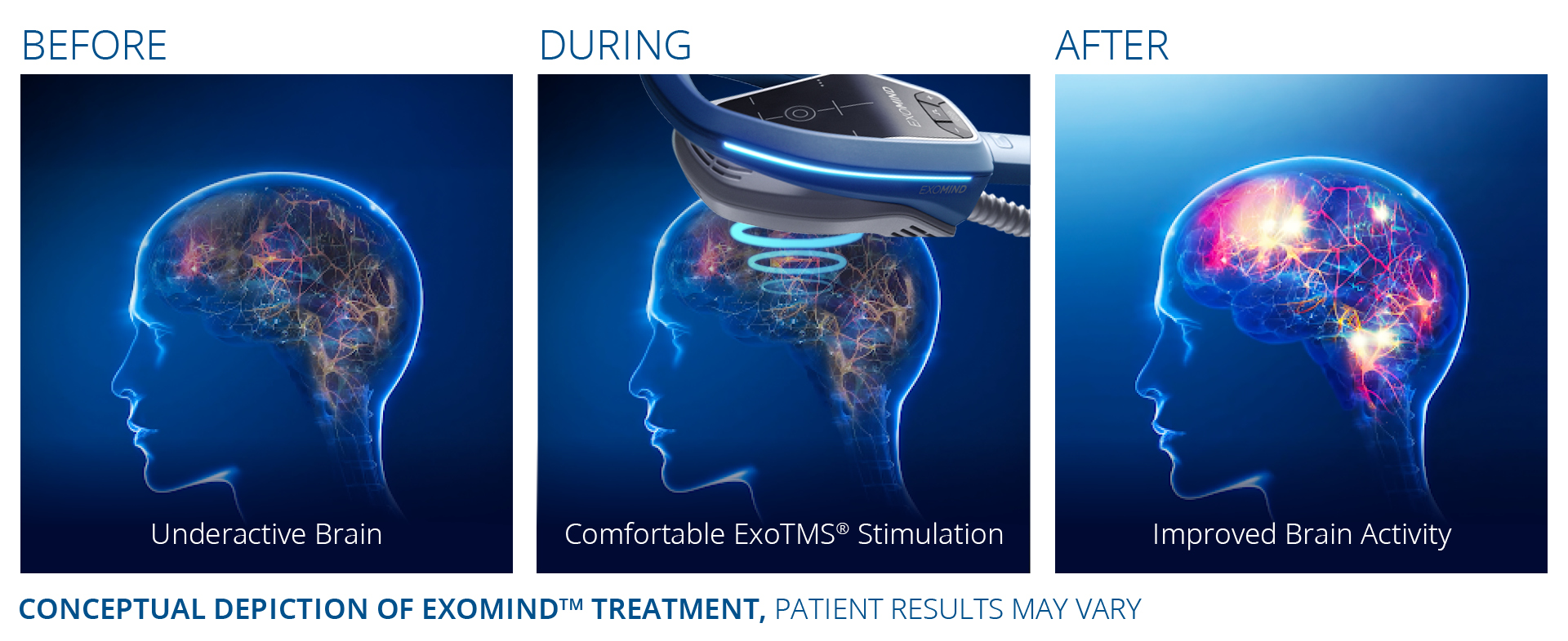 Illustration of brain activity during EXOMIND ExoTMS therapy, showing stimulation of neural pathways involved in mood, focus, and impulse control