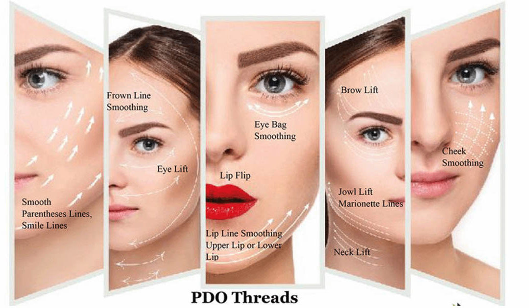 PDO thread lift treatment at Desert Sands Aesthetics & Laser, St. George Utah