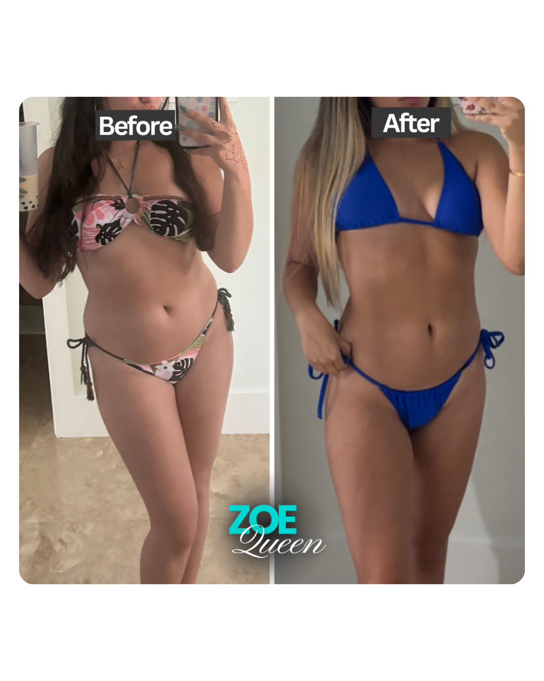 Zoe patient before and after weight loss and surgery