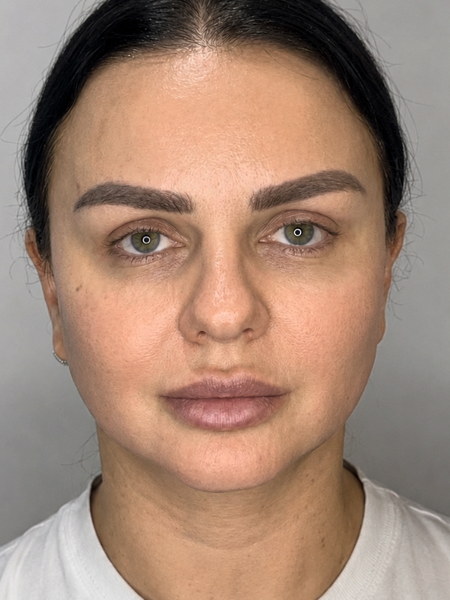 Patient after BBL