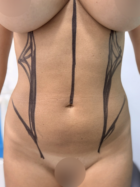 Patient before breast augmentation