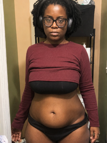 Patient before tummy tuck
