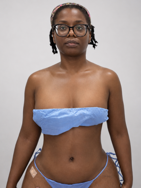 Patient after tummy tuck