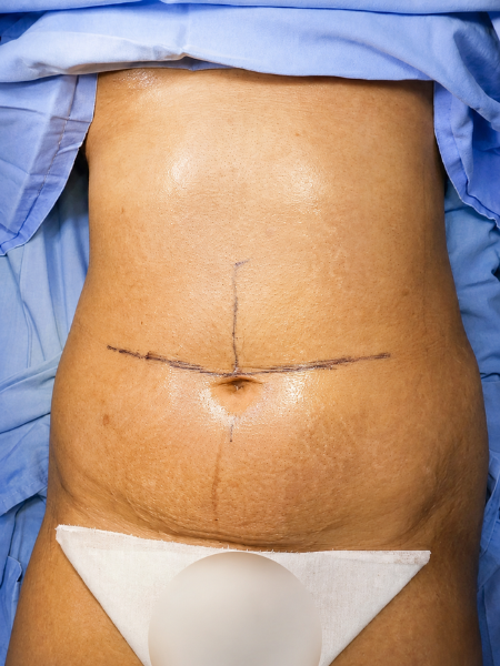 Patient before rhinoplasty
