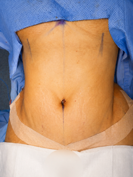 Patient after rhinoplasty
