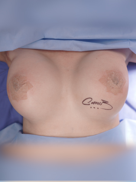 Patient after breast augmentation