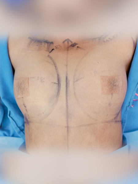 Patient before breast augmentation