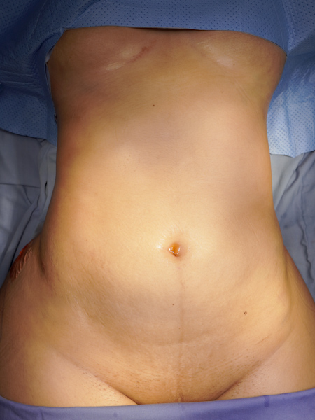 Patient before abdominoplasty