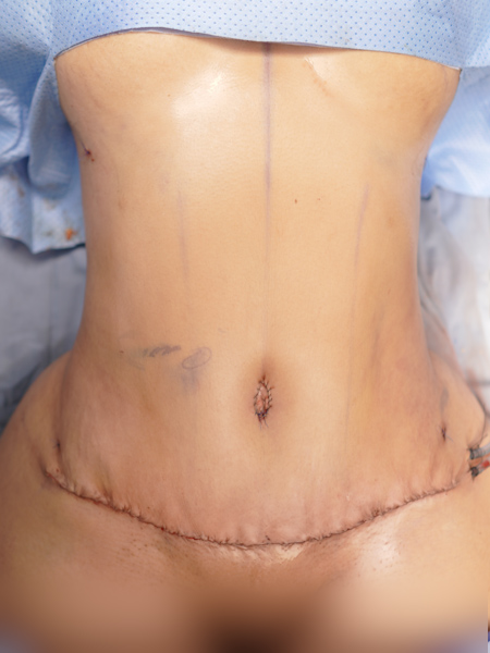 Patient after abdominoplasty