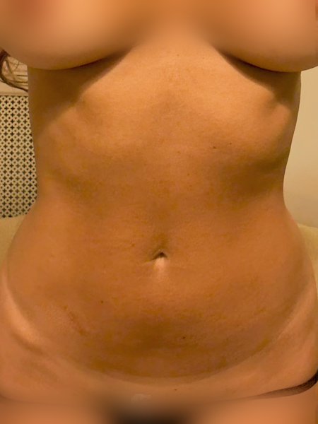 Patient before breast augmentation