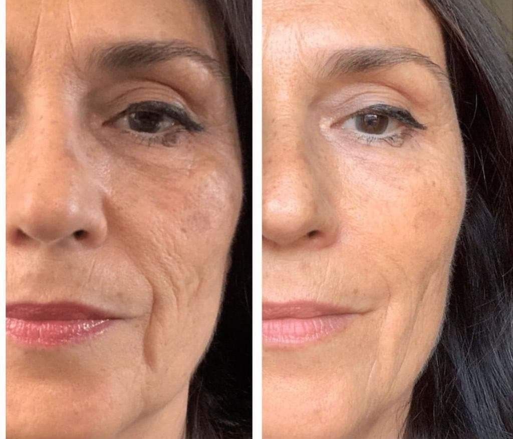 Matis Plump Facial