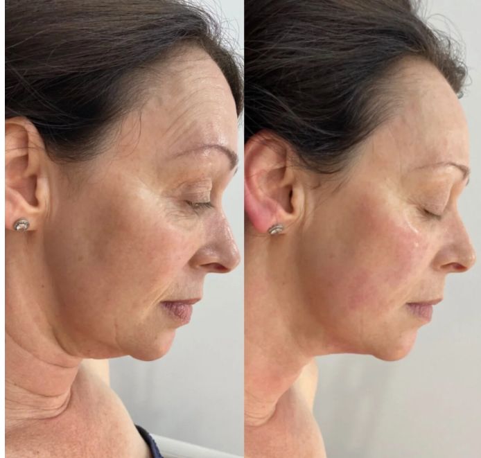 Tratamiento Hifu Fill iSalud