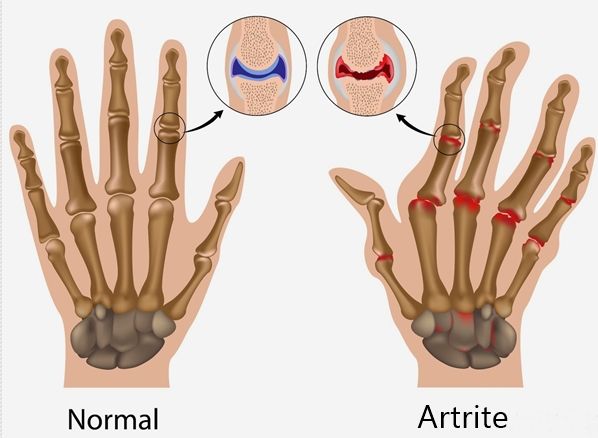 Consulta reumatologia iSalud