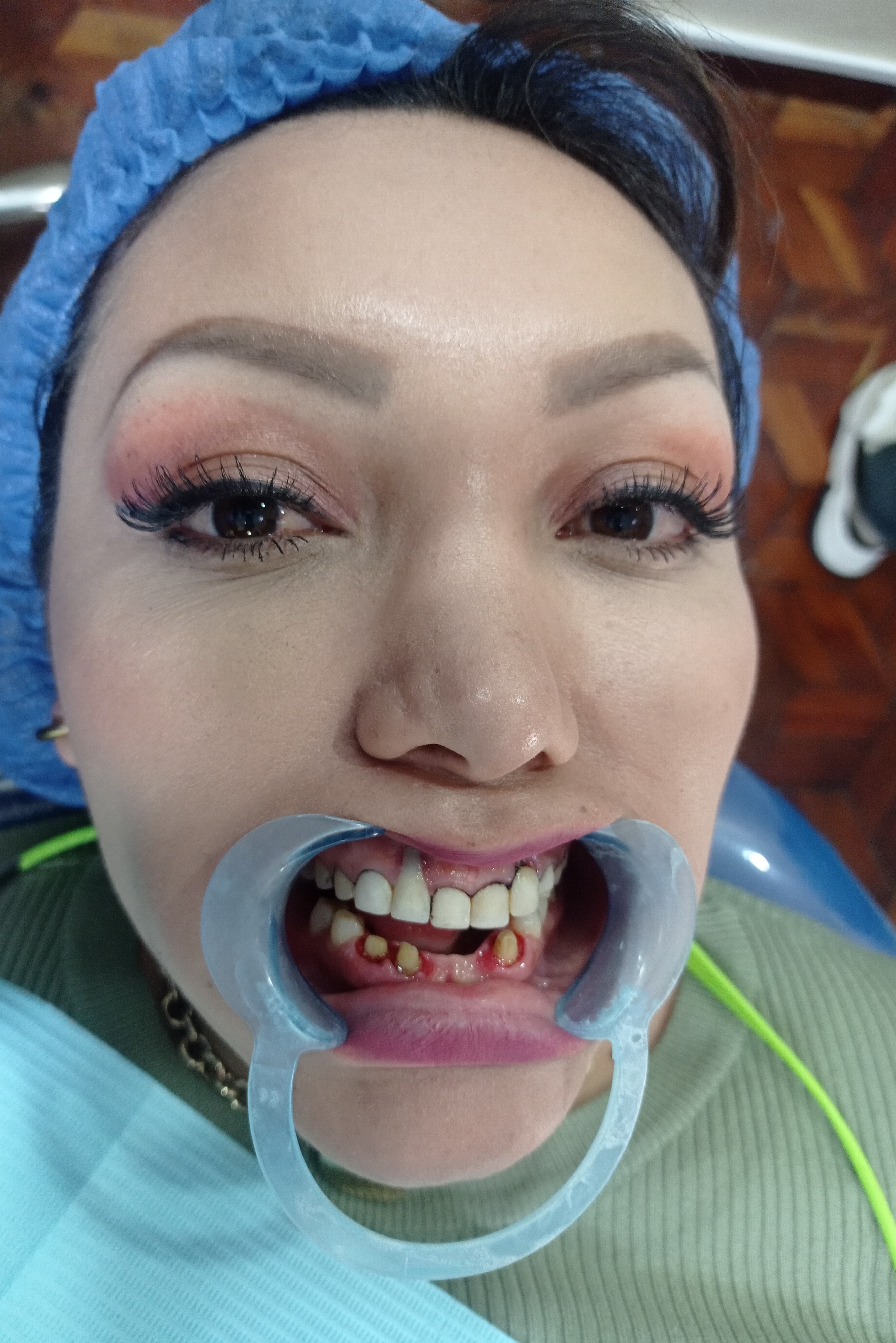 Antes