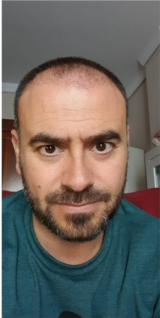 Antes caso 2