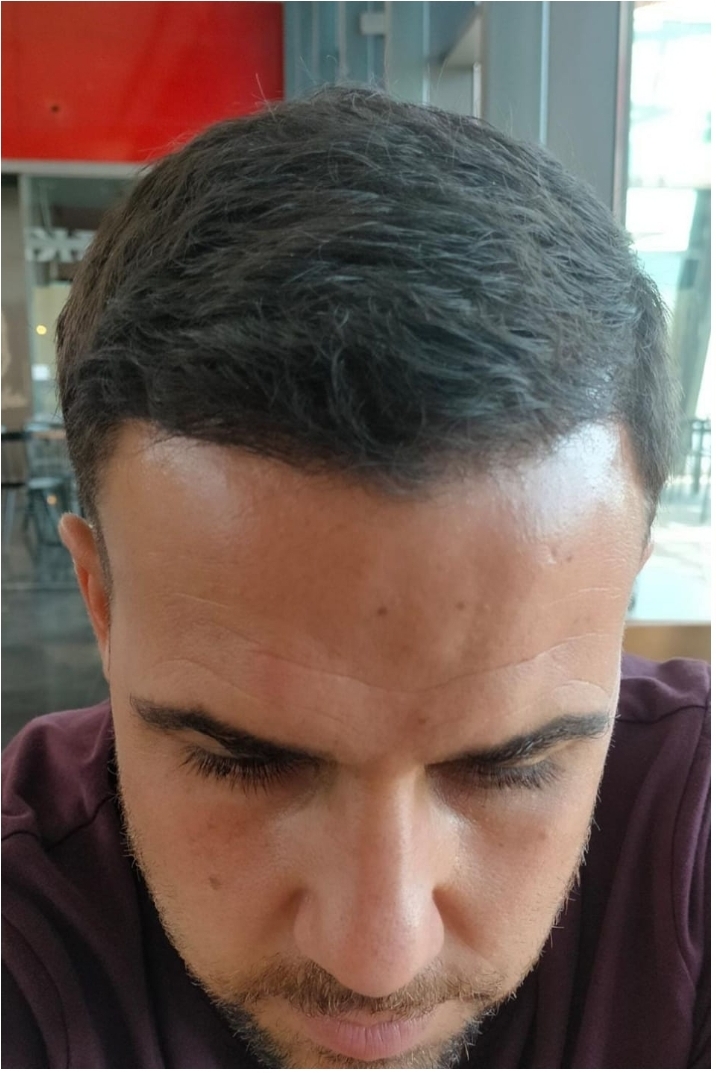Después caso 6