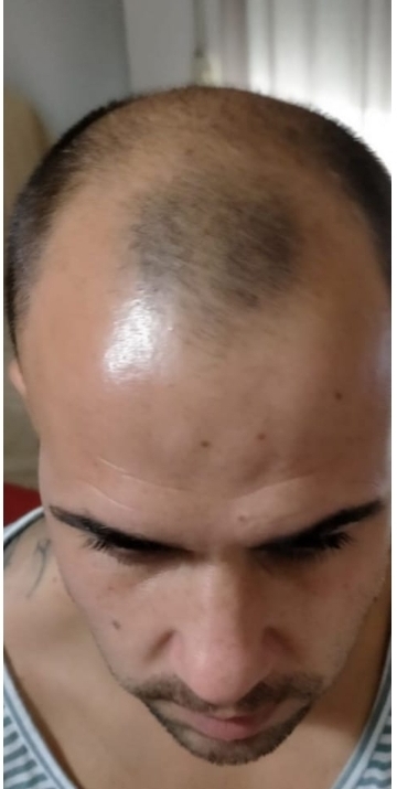 Antes caso 6