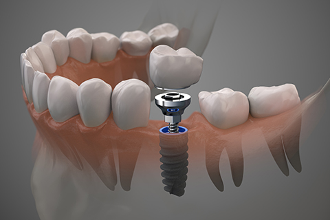 Dental Implants