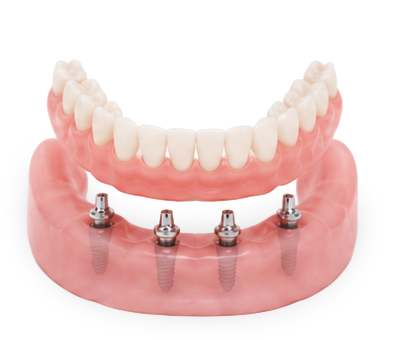 Implant-Supported Overdentures