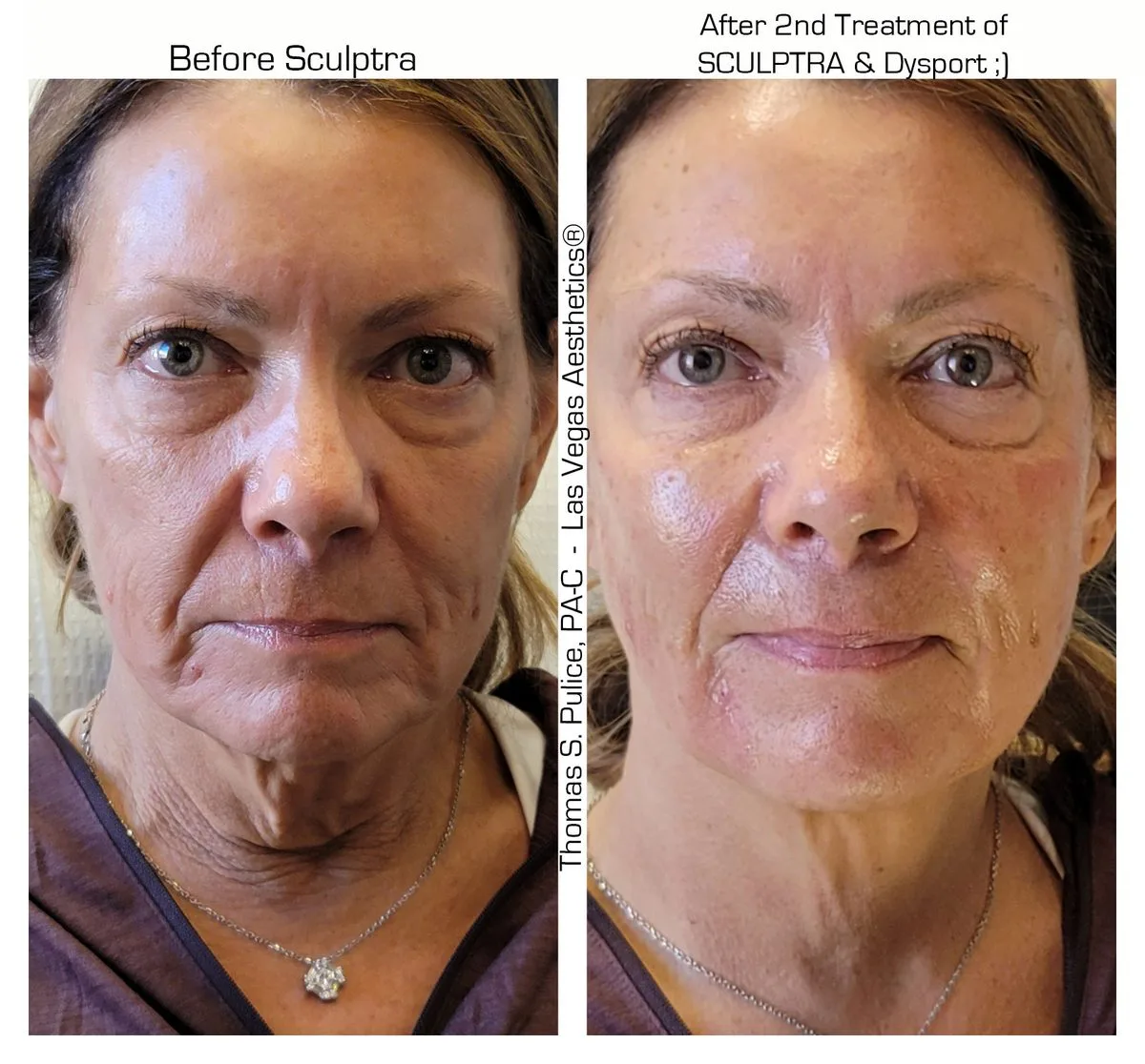 Sculptra and Dysport before and after, 2nd treatment, Las Vegas Aesthetics