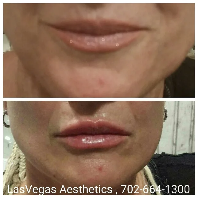 Lip filler before and after, Las Vegas Aesthetics