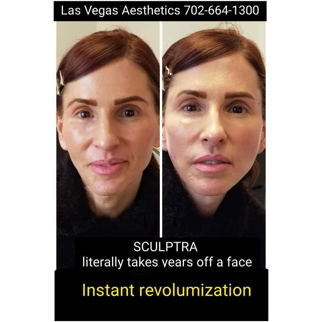 Sculptra before and after, instant revolumization, Las Vegas Aesthetics