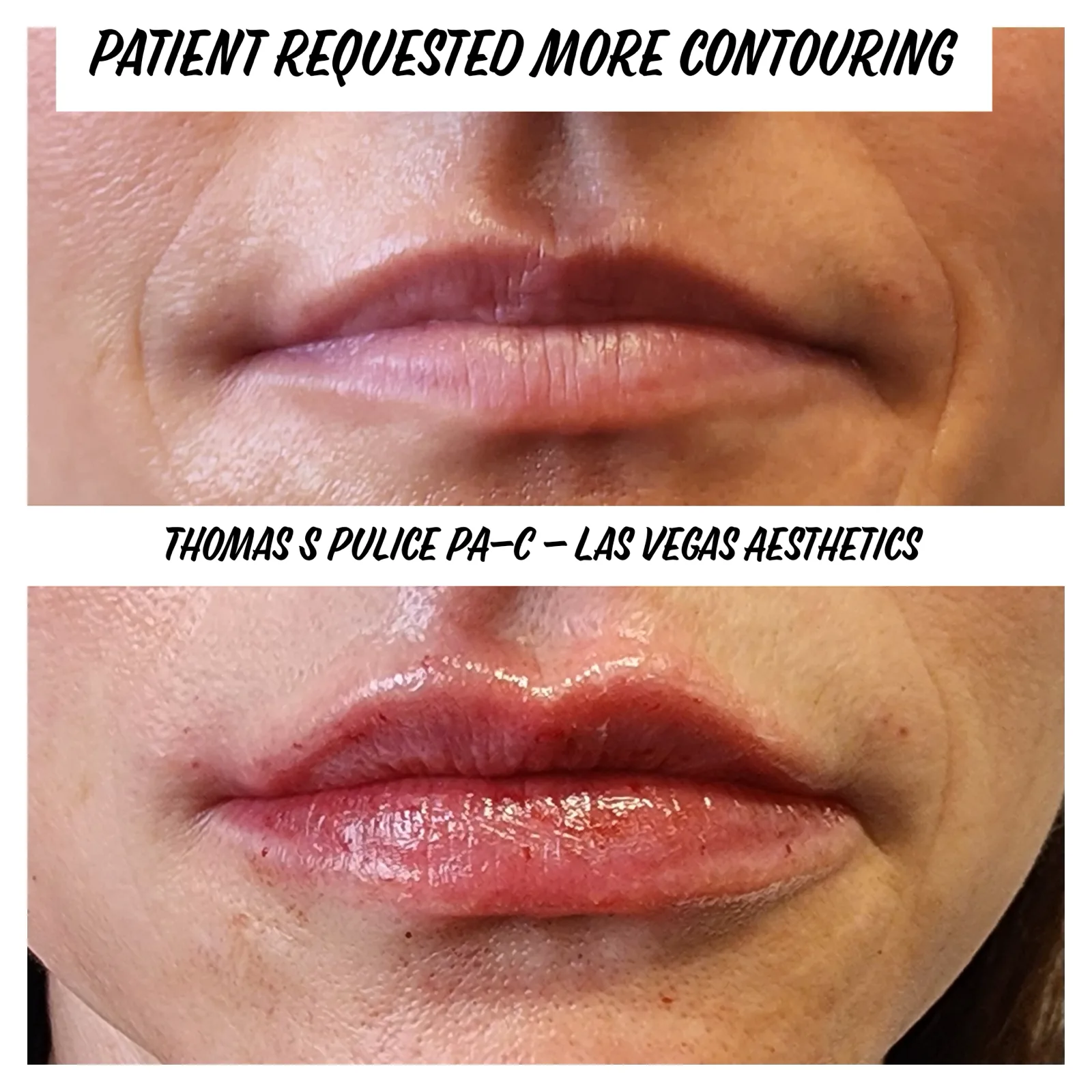 Lip filler before and after, more contouring requested, Las Vegas Aesthetics