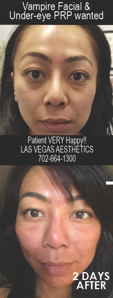 Vampire Facial before and after, under-eye PRP, Las Vegas Aesthetics