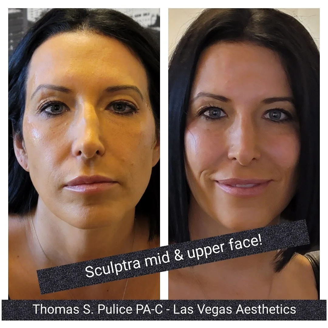 Sculptra before and after, mid and upper face, Las Vegas Aesthetics