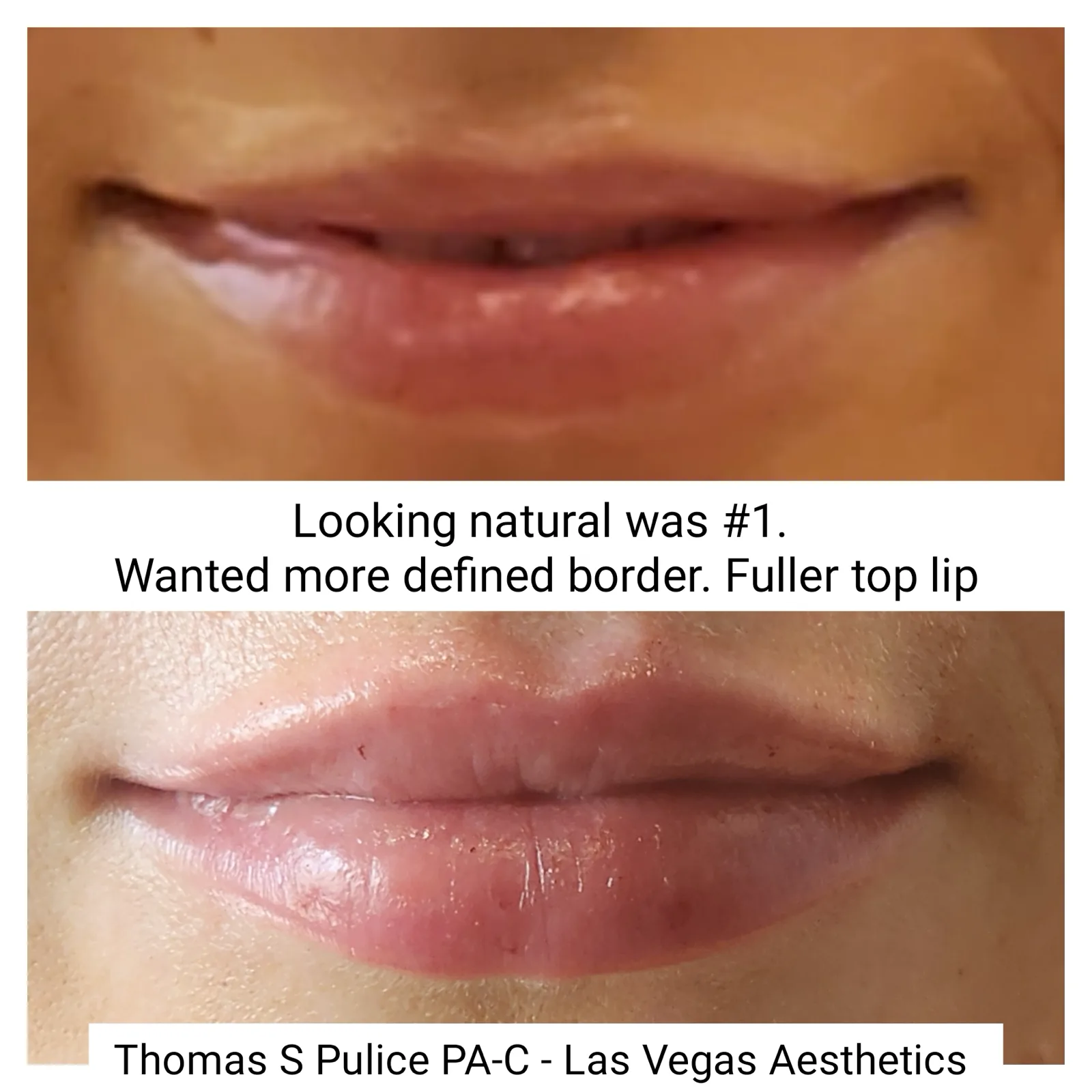 Lip filler before and after, defined border and fuller top lip, Las Vegas Aesthetics