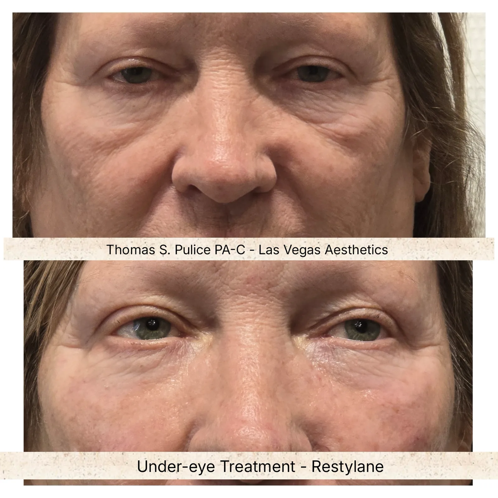 Under-eye filler before and after, Las Vegas Aesthetics