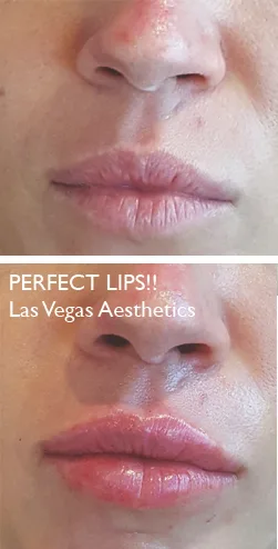 Lip filler before and after, Las Vegas Aesthetics