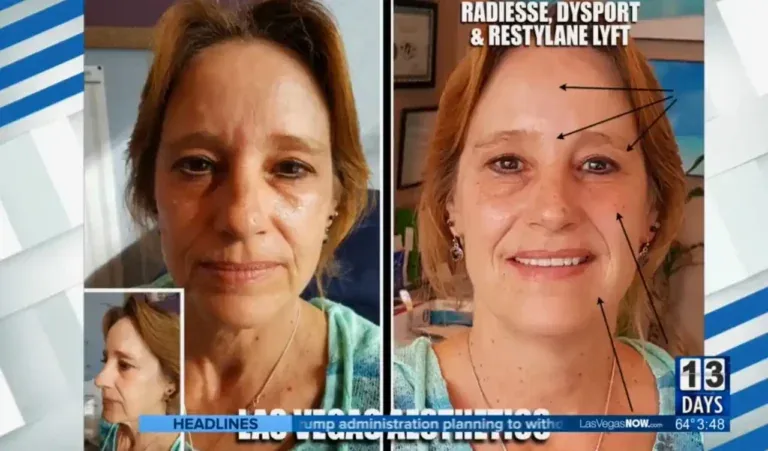 CBS News feature, Dysport and Restylane results, Las Vegas Aesthetics