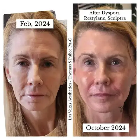 Dysport before and after, forehead and frown lines, Las Vegas Aesthetics