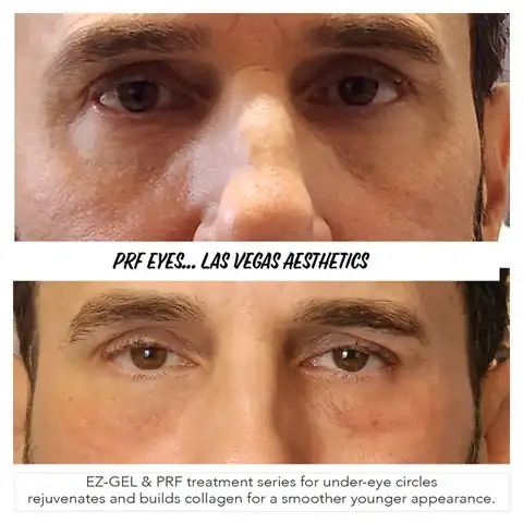 EZ Gel before and after result 2