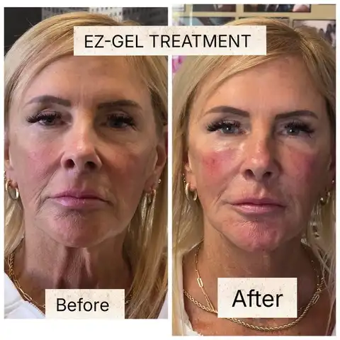 EZ Gel before and after result 3