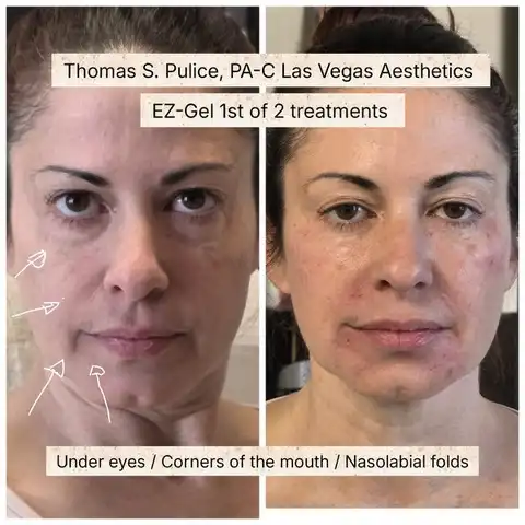 EZ Gel before and after result 1