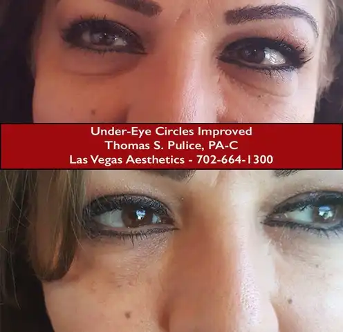 EZ Gel before and after result 4