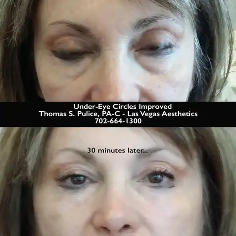 EZ Gel before and after result 5