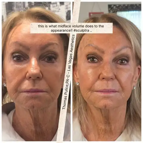 Sculptra before and after, midface volume restoration, Las Vegas Aesthetics