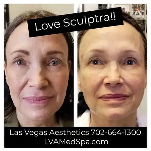 Sculptra before and after, under-eye and cheek volume, Las Vegas Aesthetics