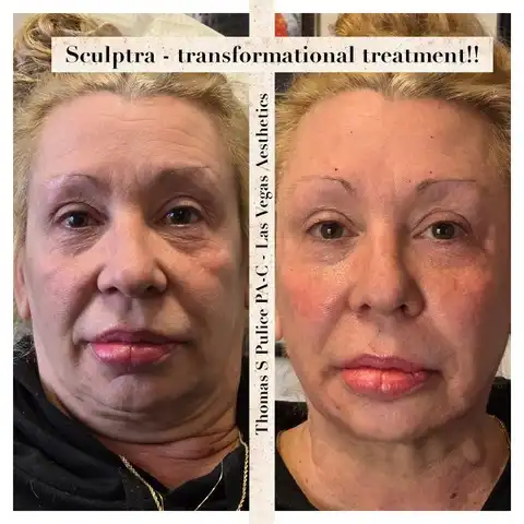Sculptra before and after transformation, full face, Las Vegas Aesthetics