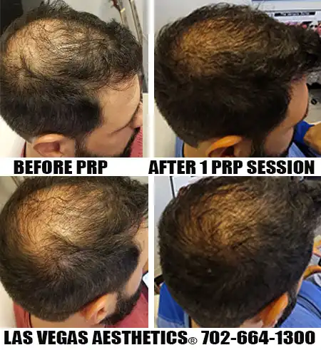 PRP hair restoration before and after, patient 4
